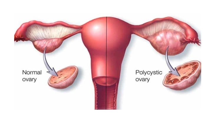 Ayurvedic Treatment for PCOD and PCOS in Thane